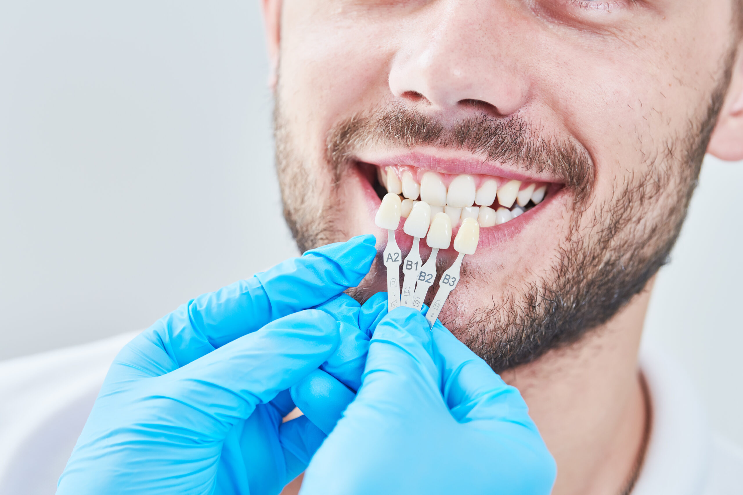 dentistry. matching colour of the tooth enamel for young man with whitening chart