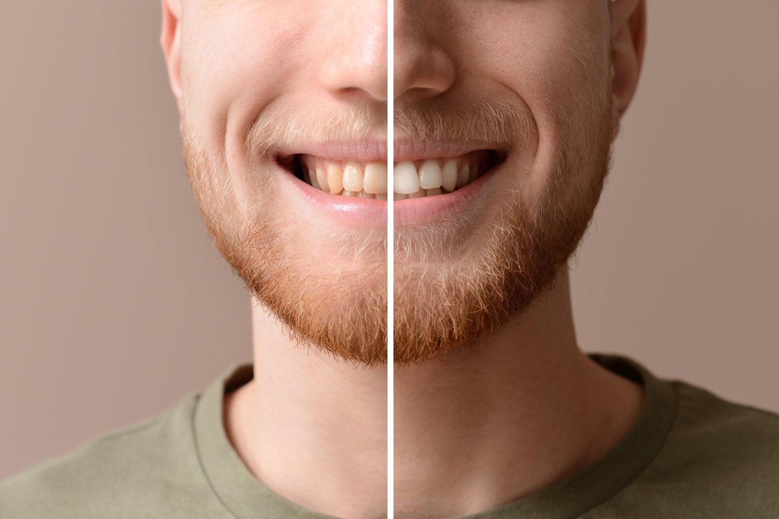 Before and after comparison of a smile whitened with professional KOR whitening treatment